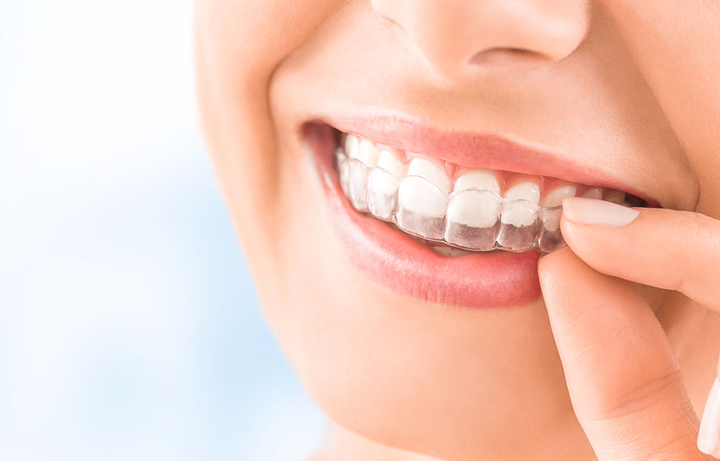 invisalign treatment